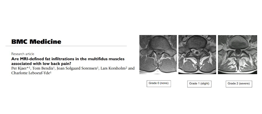Are MRI defined fat infiltrations in the multifidus muscles associated with low back pain Mainstay Medical Australia
