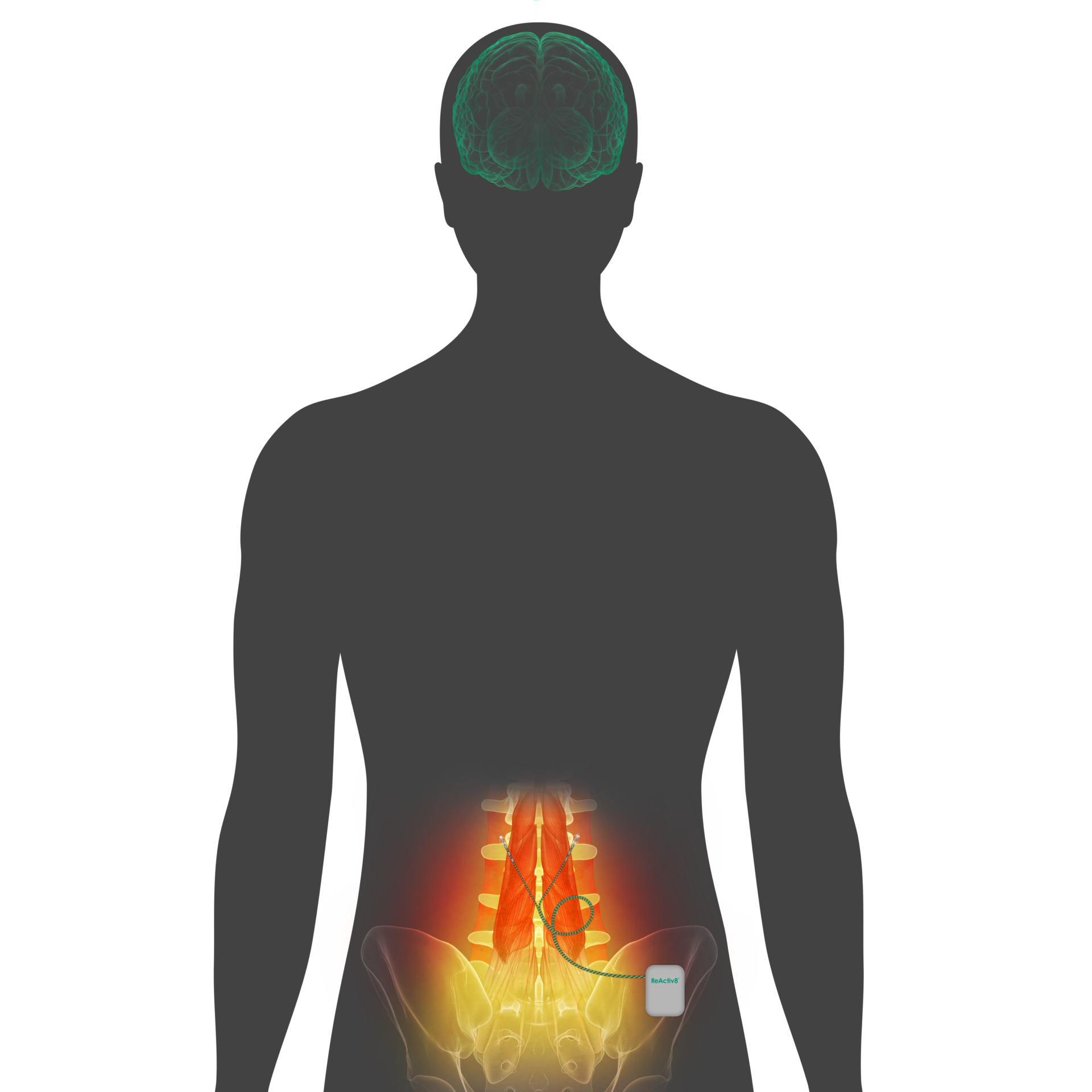 Multifidus Muscle dysfunction and Reactiv8